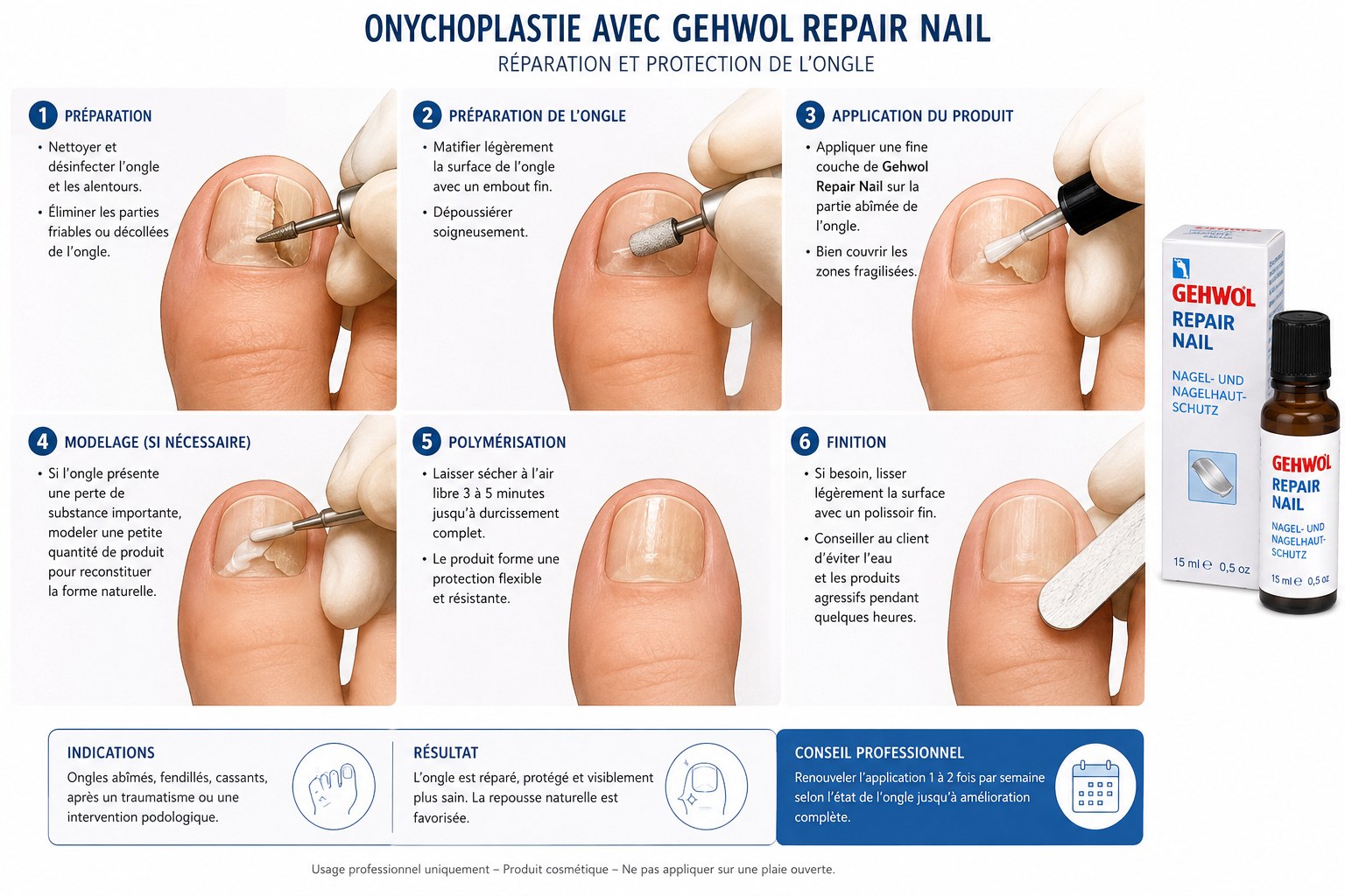 Protocole de reconstruction d'ongle avec Gehwol Repair Nail en 6 étapes