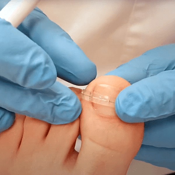 Pose d'un fil d'orthonyxie sur un ongle incarné à Hannut